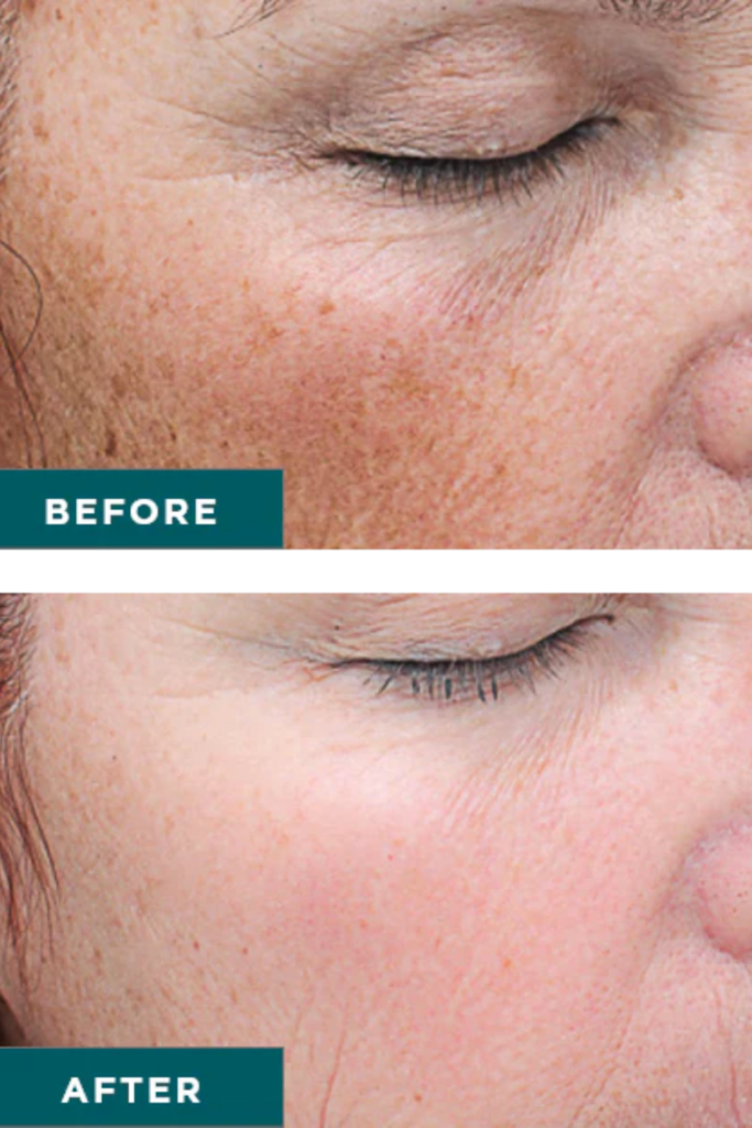 before and after picture of woman who got a chemical peel for discoloration